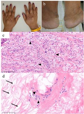 Case report: Cerebrotendinous xanthomatosis with a novel mutation in the CYP27A1 gene mimicking behavioral variant frontotemporal dementia